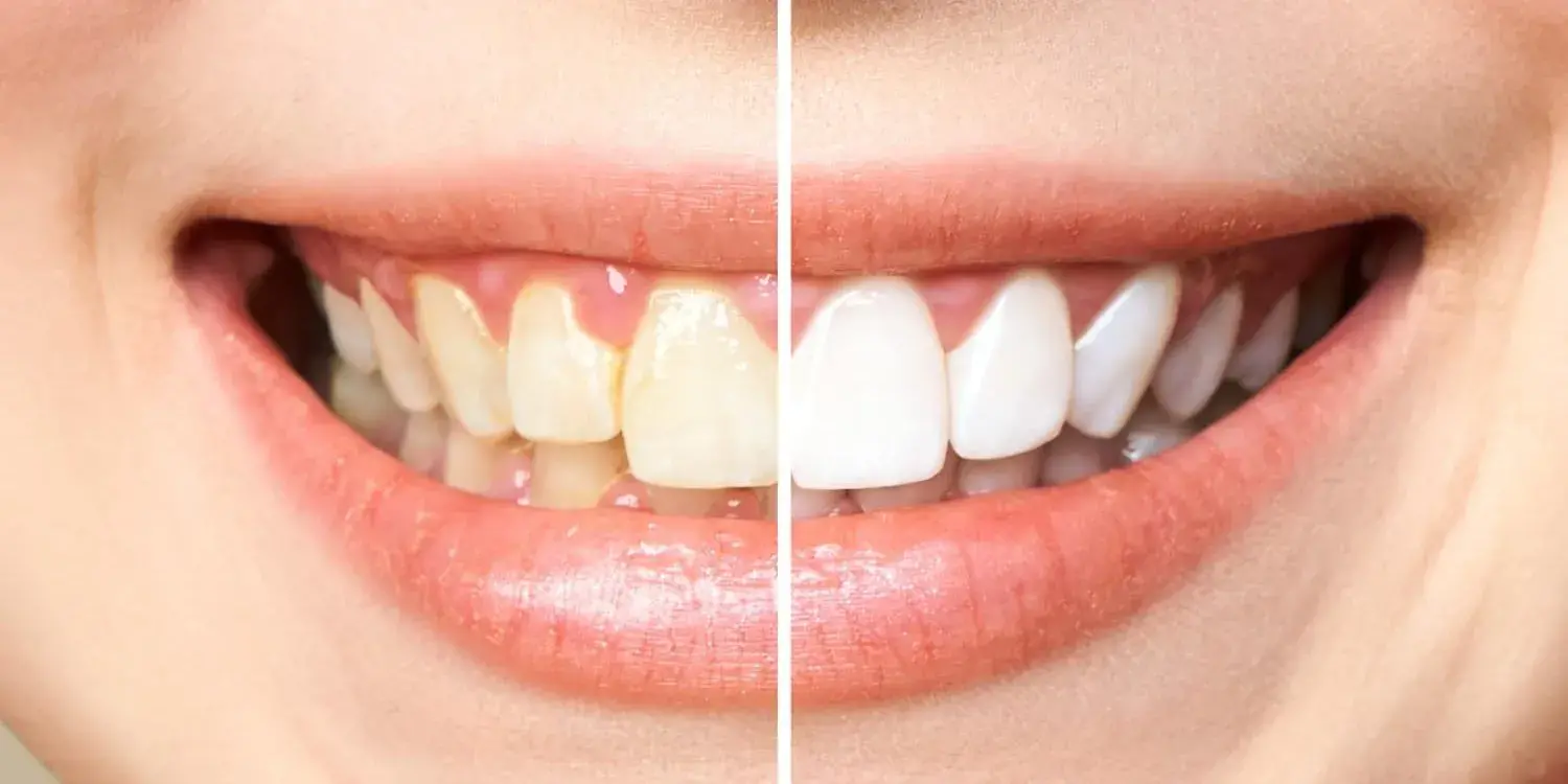 Imagen del servicio de Limpieza dental